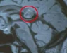 Рендген откри невообичаена маса во мозокот на девојчето! Лекарите итно го оперирале, а потоа следел нов шок