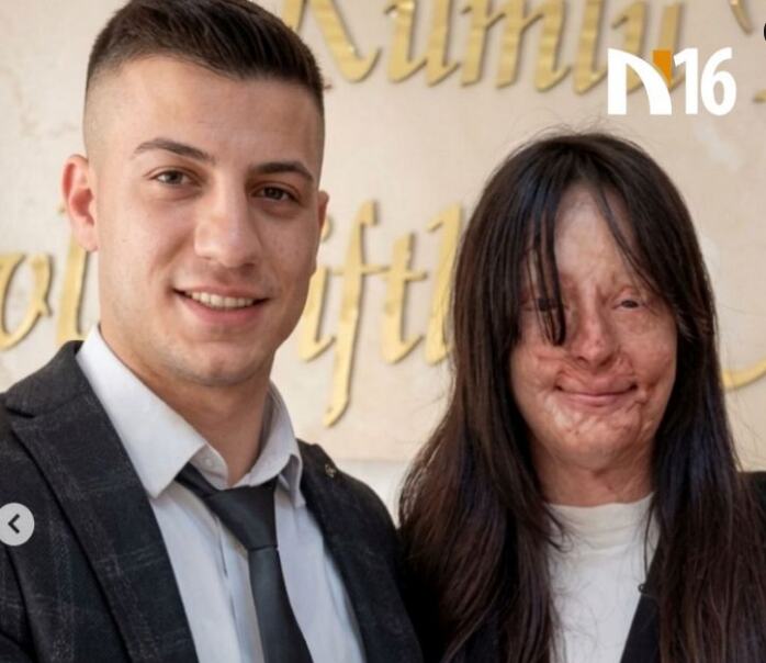Нејзиниот бивш ѝ фрли киселина во лице, а таа сепак се омажи за него: Сè направи во тајност, нејзиниот татко полуде кога слушна